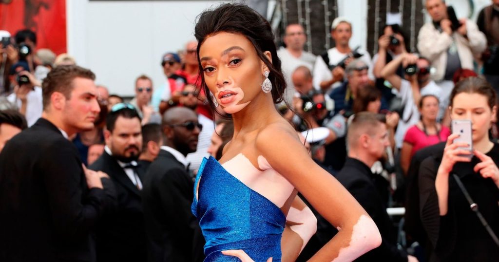 9 Models Who Changed The Definition of Beauty in Their Favor
