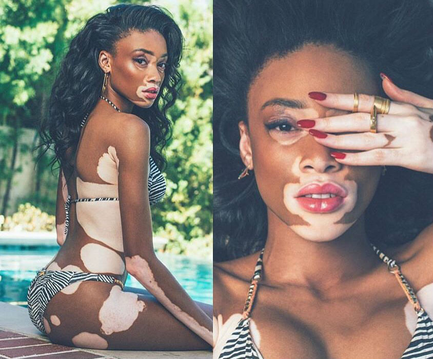 9 Models Who Changed The Definition of Beauty in Their Favor