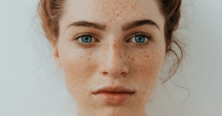 1.What Causes Freckles | 8 Things You Never Knew About Freckles | Brain Berries