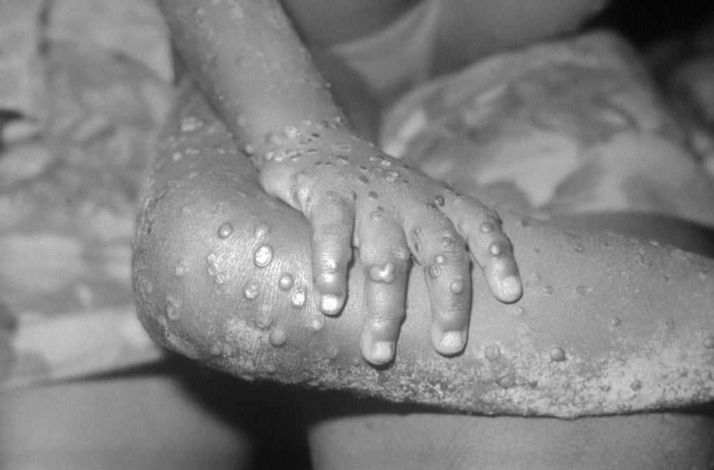 Will Monkeypox Become the New COVID?