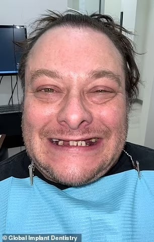 John Connor from “Terminator 2” Is Unrecognizable After Replacing His Rotted Teeth