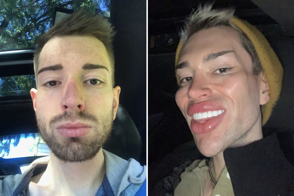 El hombre que quiso ser el novio de Barbie deshace sus cirugías plásticas