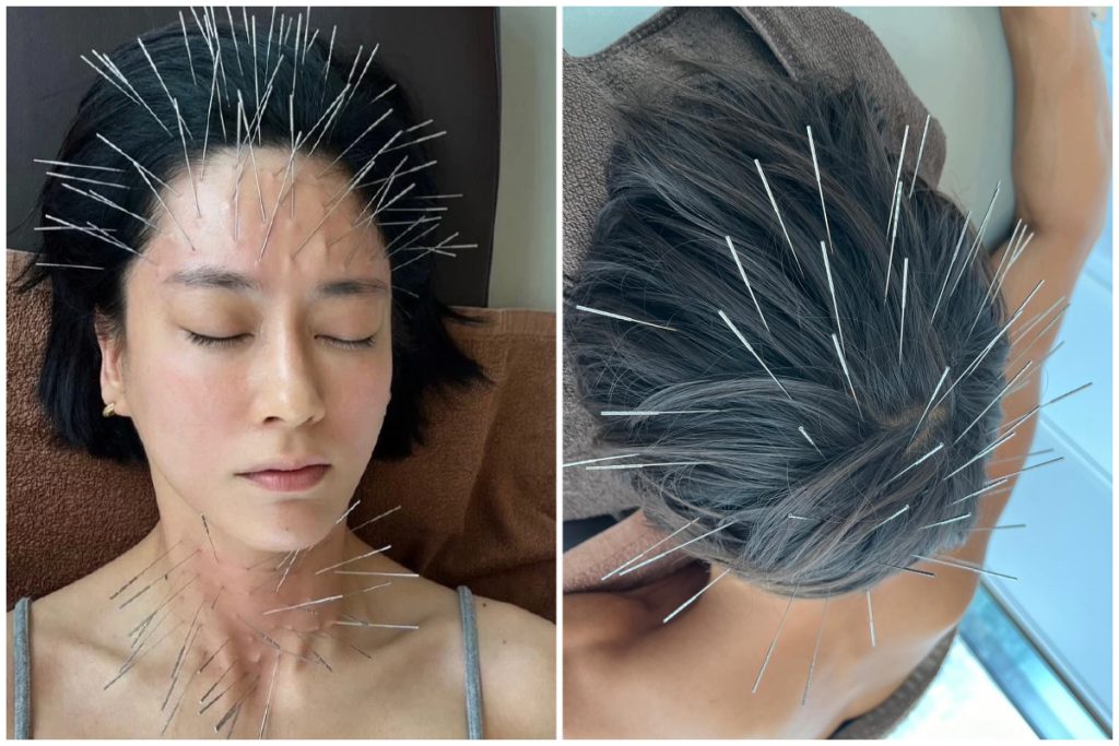 Viral, Klinik Akupunktur Jepang Ini Mengubah Orang Seperti Landak!