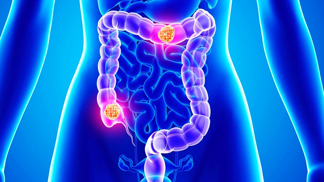 ≡ Cáncer silencioso: cinco tipos a los que hay que prestar atención y ...
