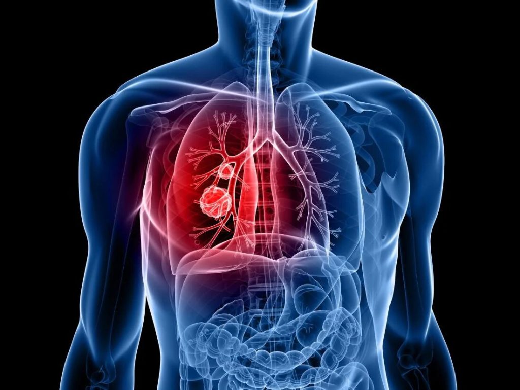 Cáncer silencioso: los cinco tipos a los que hay que prestar atención